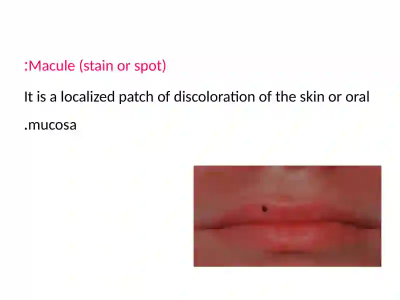 Oral infection 4
