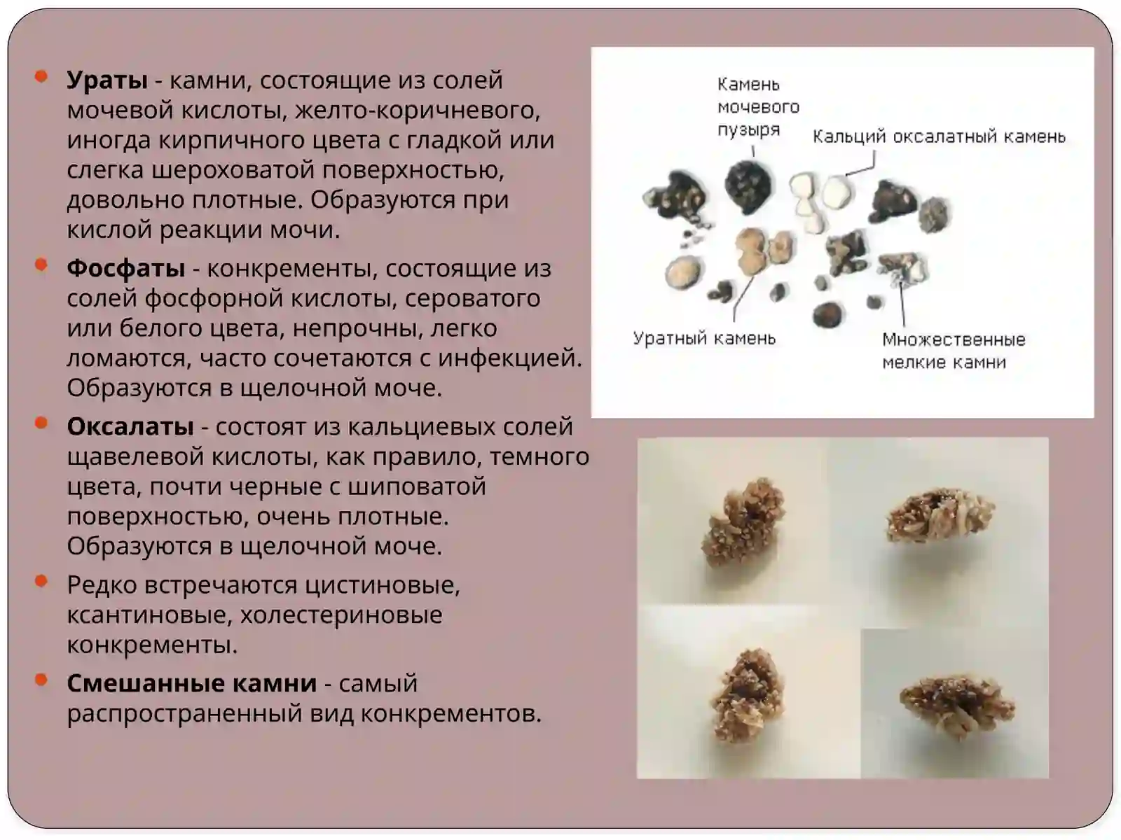 Мочекаменная болезнь 4