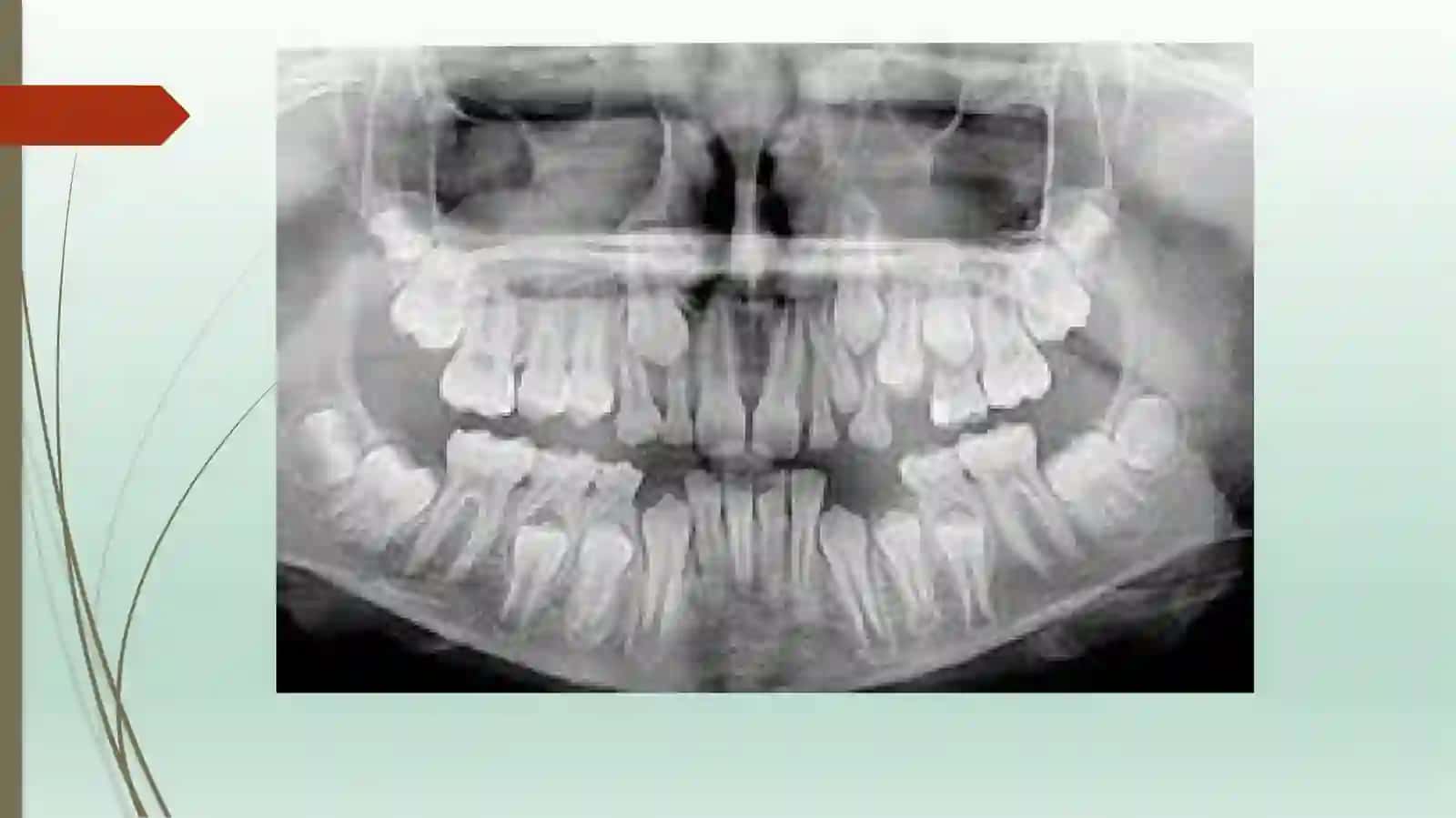 Odontoparodontogramma tahlili 4