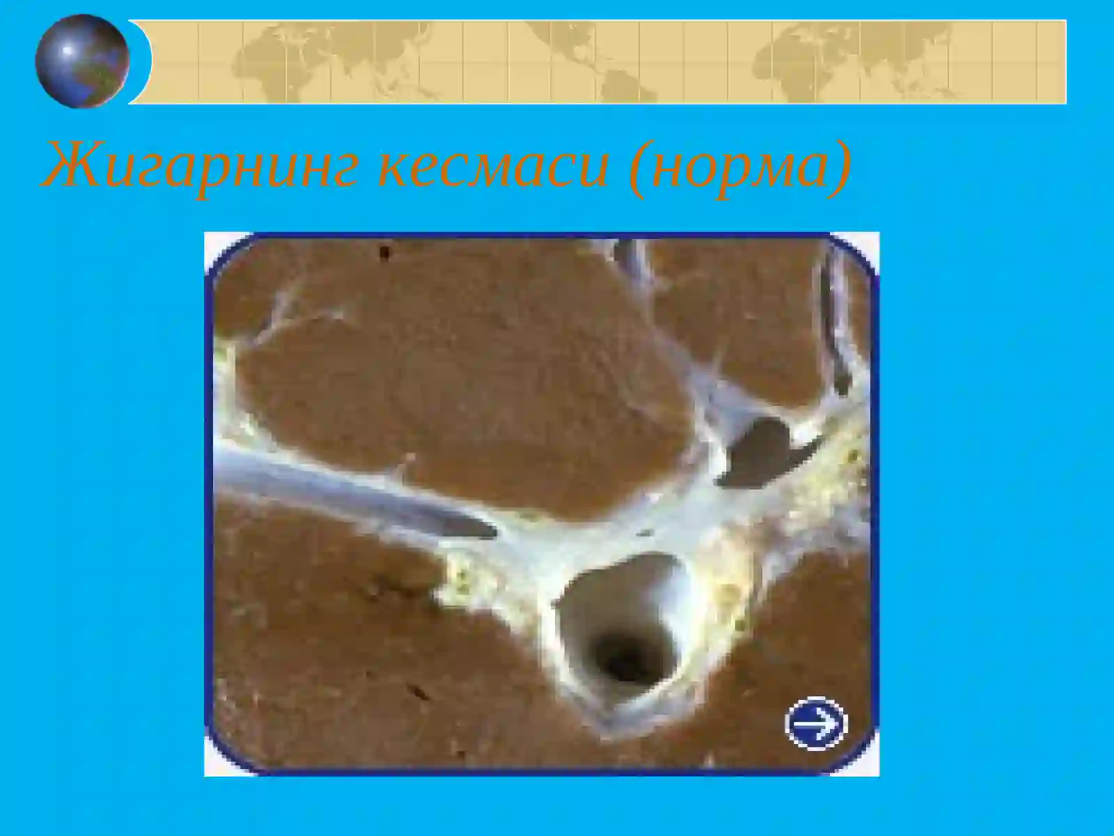 СУРУНКАЛИ ГЕПАТИТ Surunkali Gepatit 4