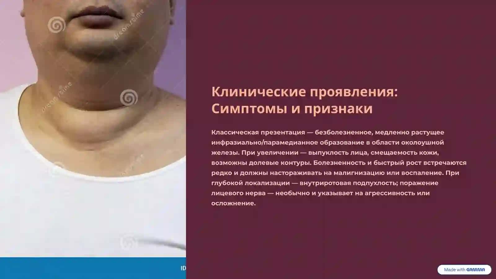 Плеоморфная аденома: Клинический обзор и лечение 4
