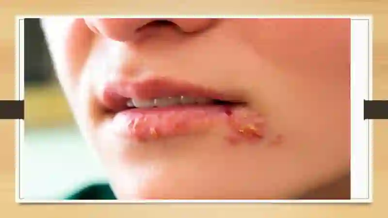 Oddiy Uchuq (Herpes Simplex) 4