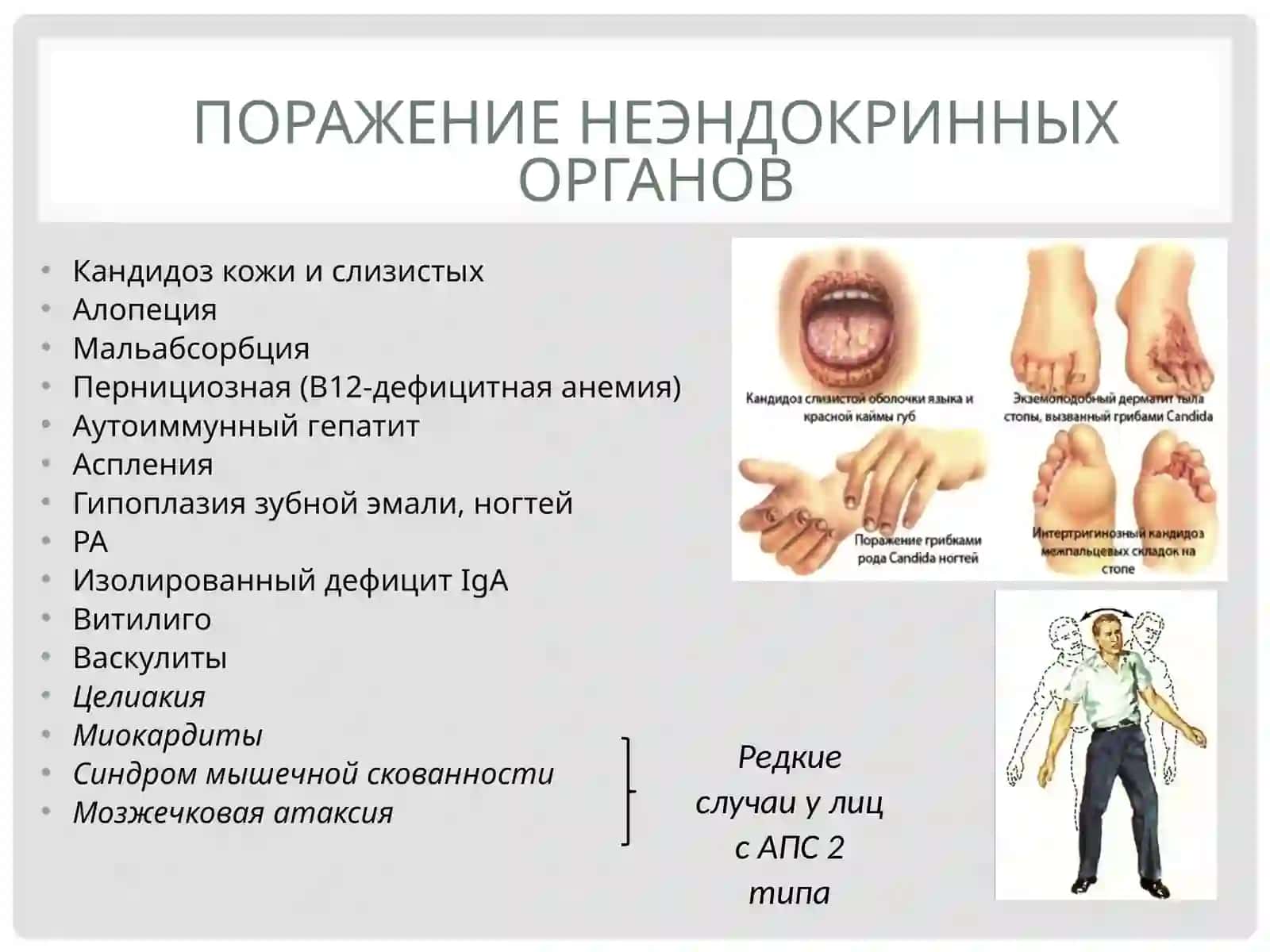 Аутоиммунныеполигландулярныесиндромы 4