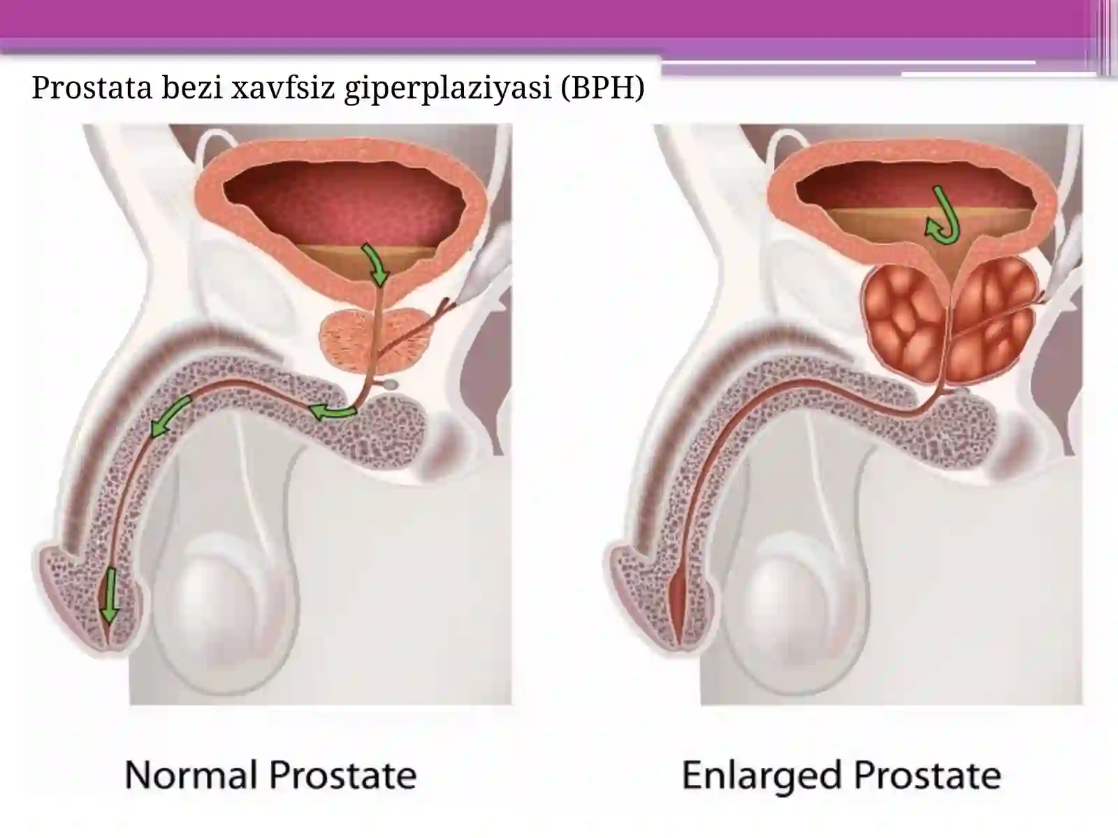 Prostata bezi o’smalari 4