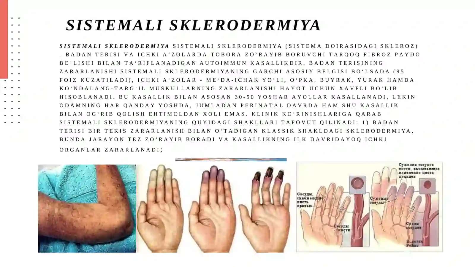Sistemalisklerodermiya 4