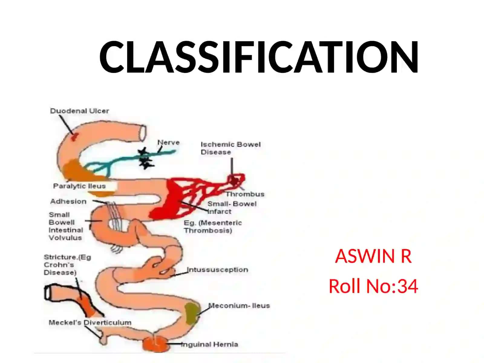 INTESTINAL OBSTRUCTION 4