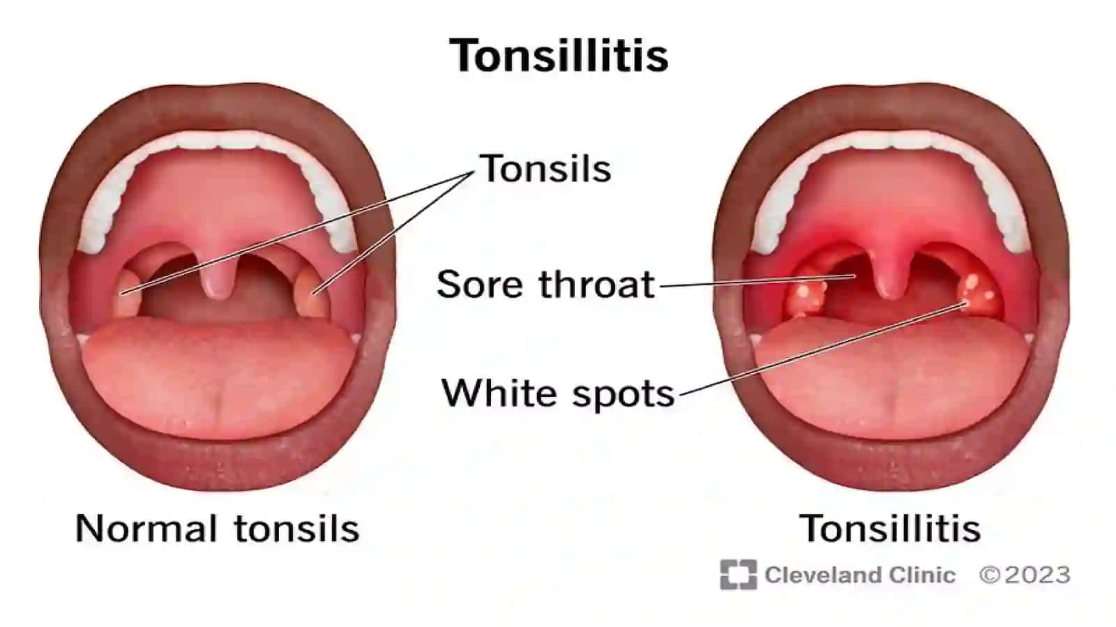 Surunkali tonzillit ; tasnifi, tashxisi, davolashi 4