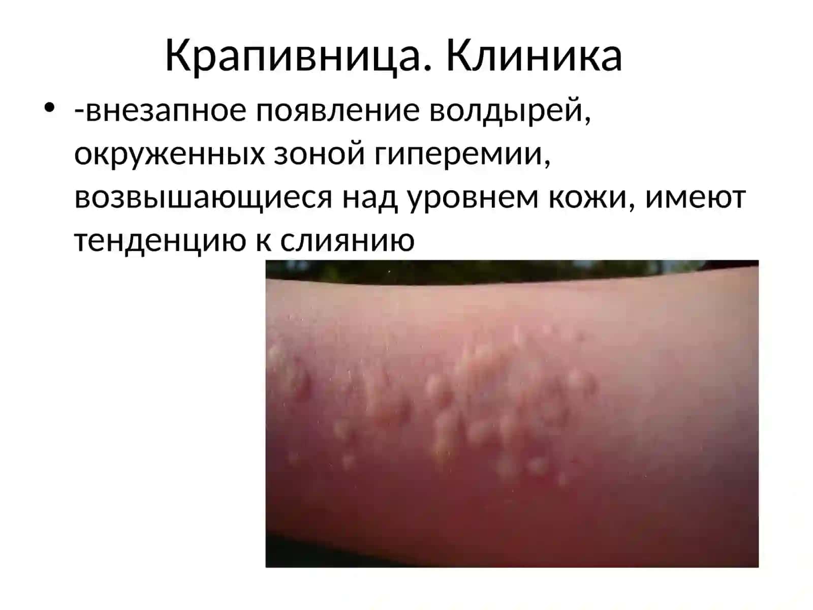 ОтекКвинке. Крапивница.Неотложная помощь 4