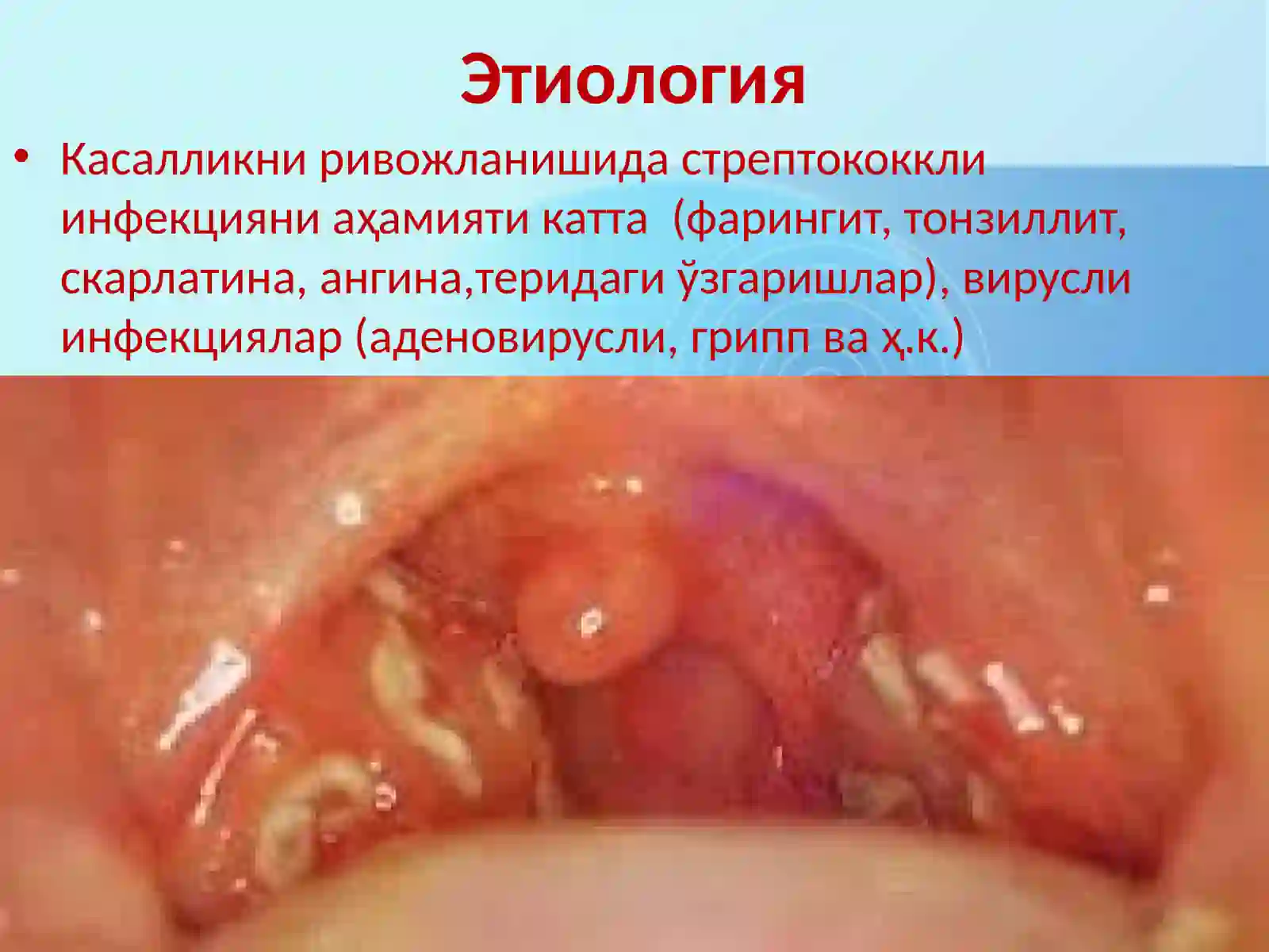 Гломерулонефрит 4