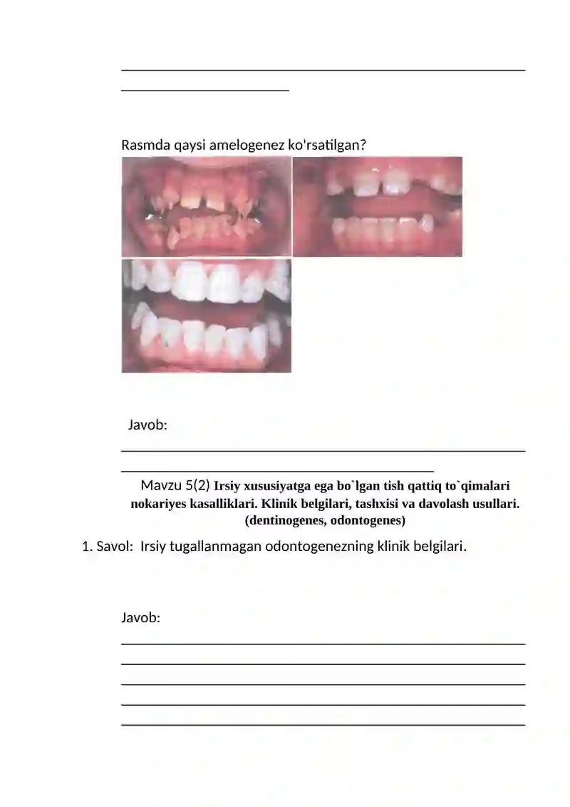 Irsiy xususiyatga ega bo`lgan tish qattiq to`qimalari nokariyes kasalliklari. Klinik belgilari, tashxisi va davolash usullari.(amelogenes) 4