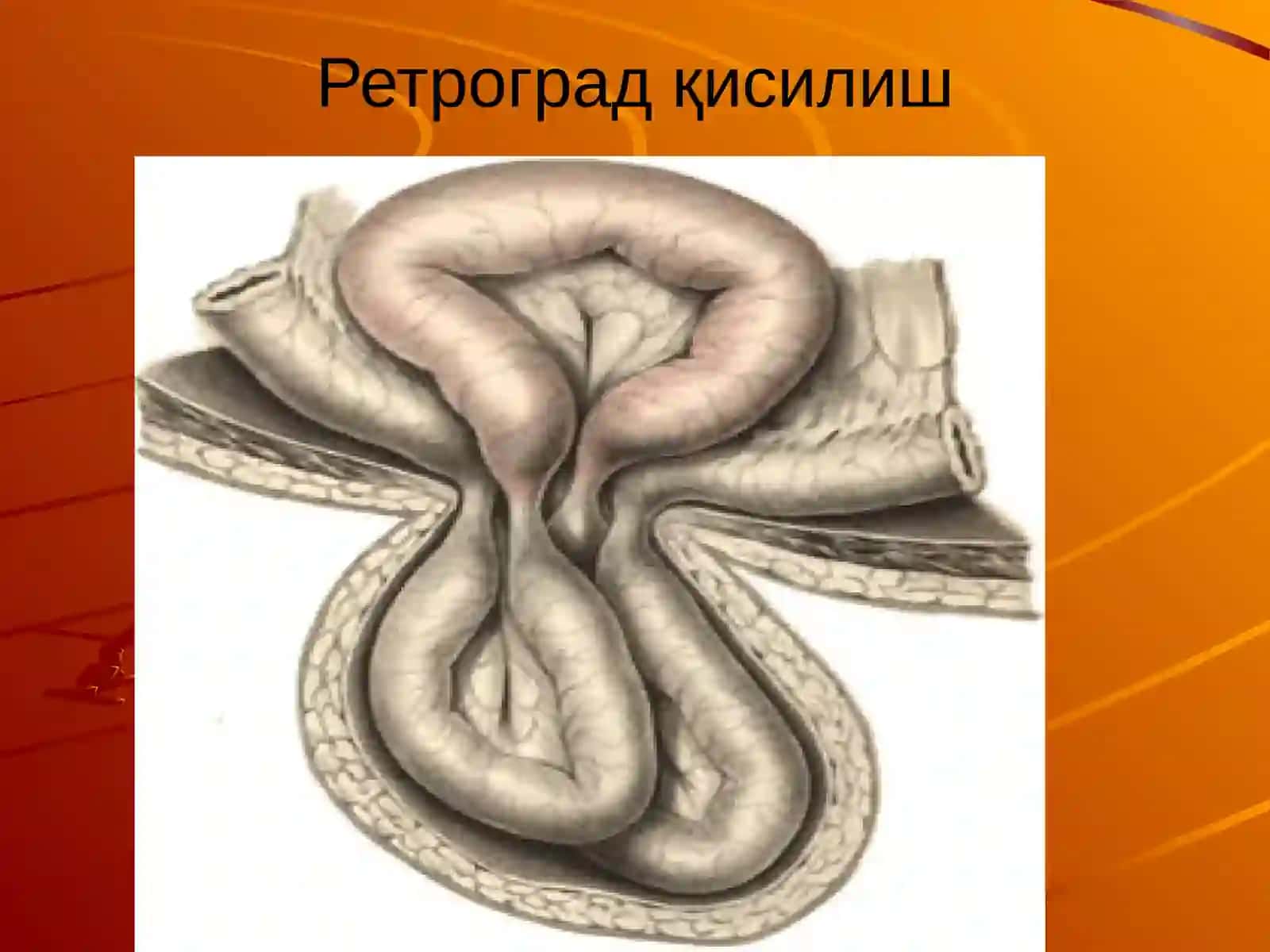 Чурра қисилиши–бу зудлик билан жарроҳлик амалиёти 4