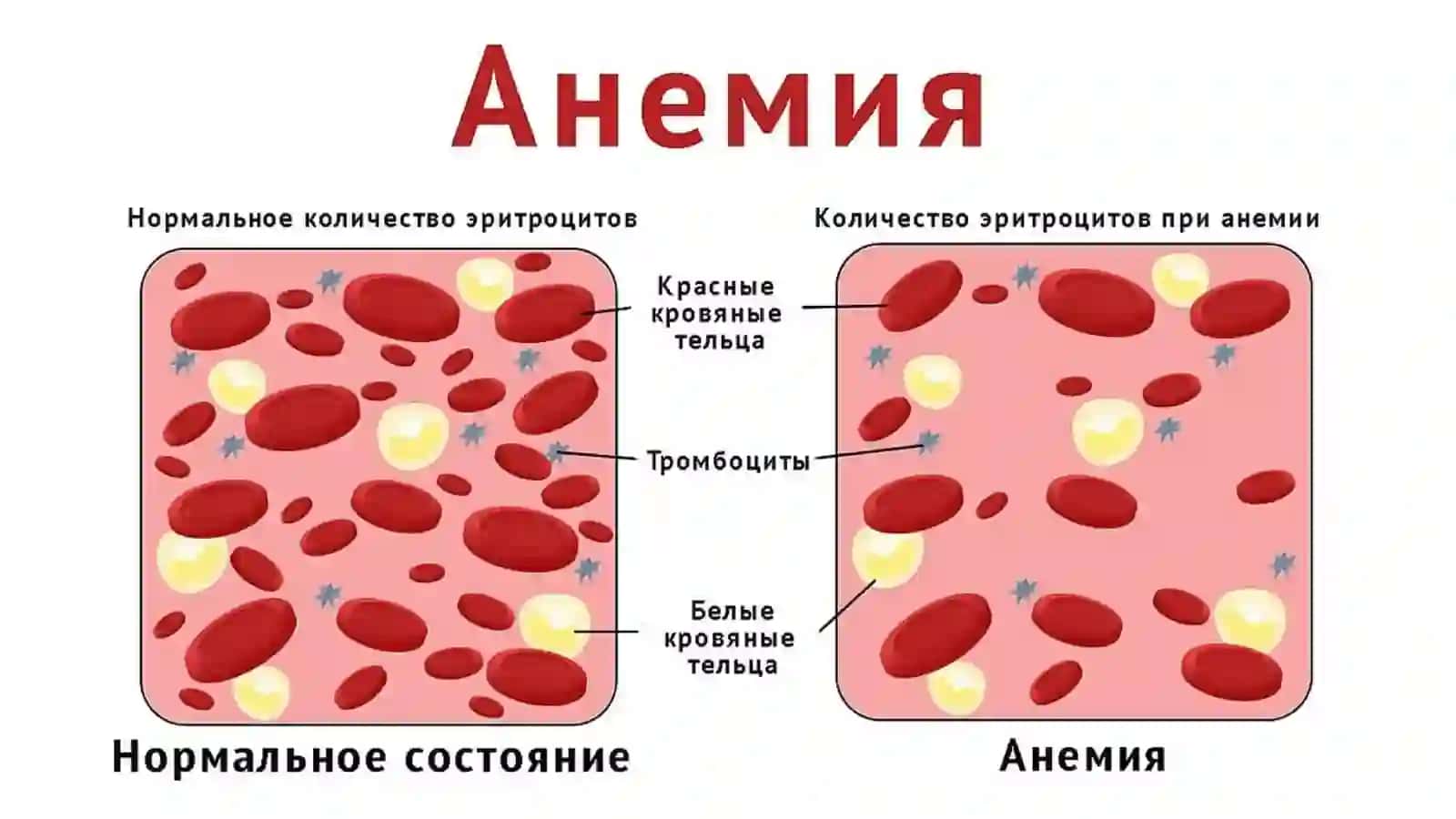 Анемия 4