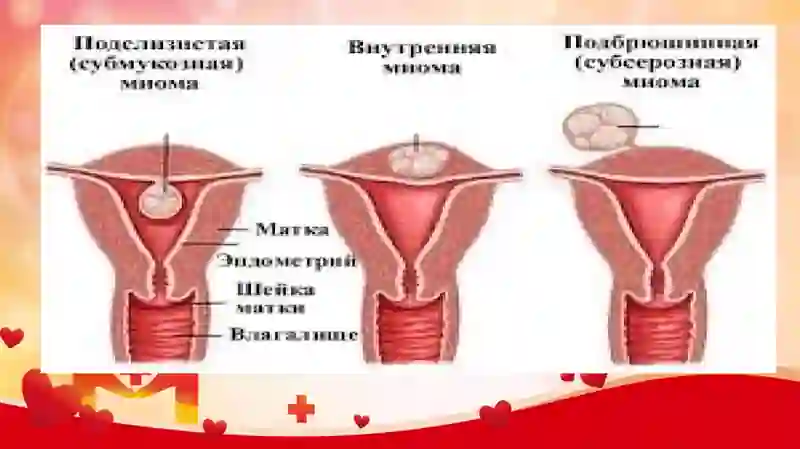 Bachadon miomasi 4