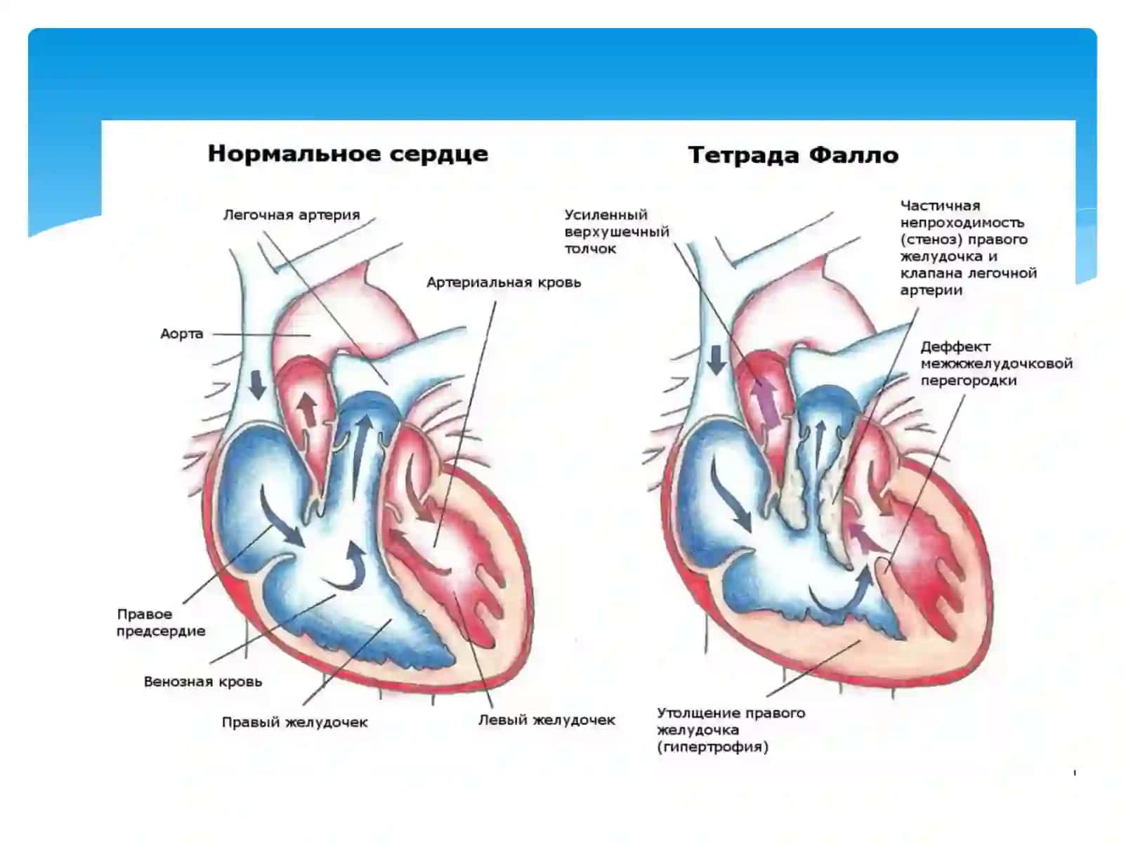ТетрадаФалло 4