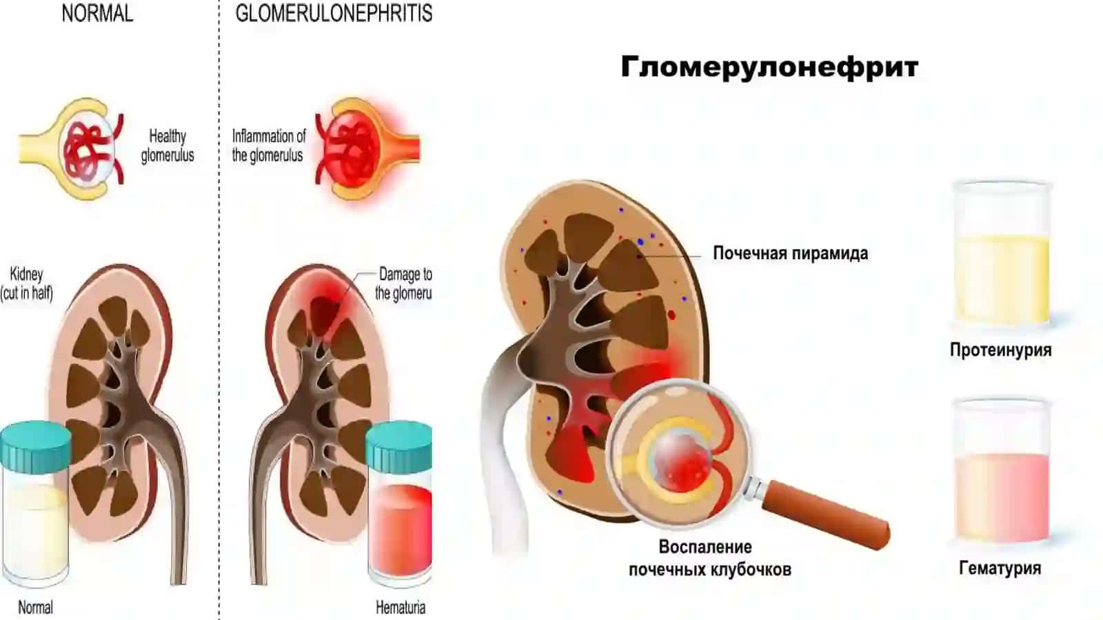 Гломерулонефрит у детей 4