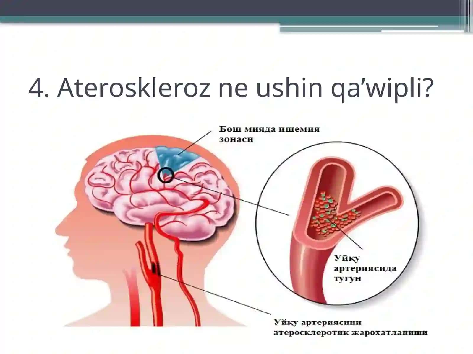 Ateroskleroz rawajlaniwi 4