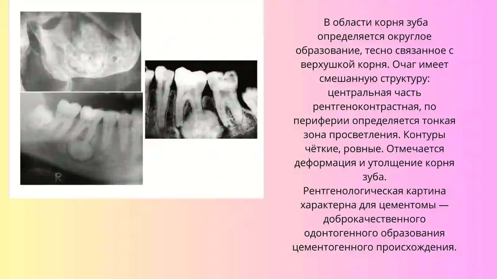 Цементома 4