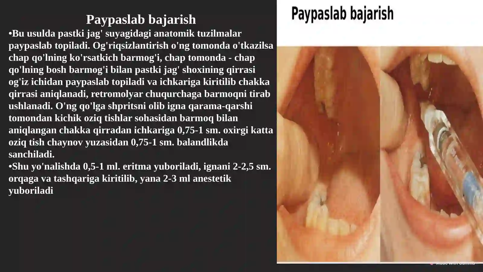 Stomatologiyada patstki jagʻda oʻtkaziladigan oʻrinsizlantirish haqida 4