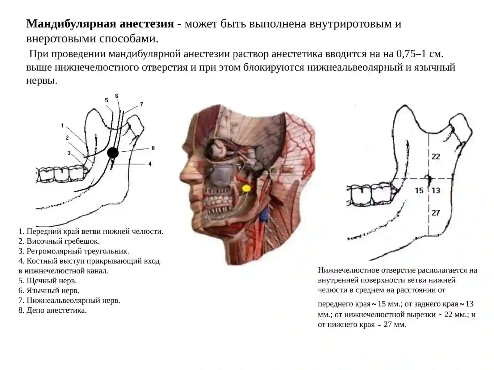 Проводниковое обезболивание на нижней челюсти 4