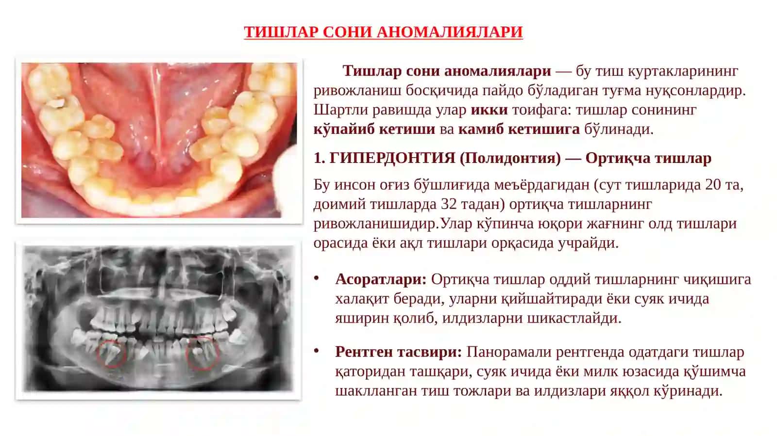 Тишлар ривожланиш аномалияларининг клиник шакллари ва таснифи 4