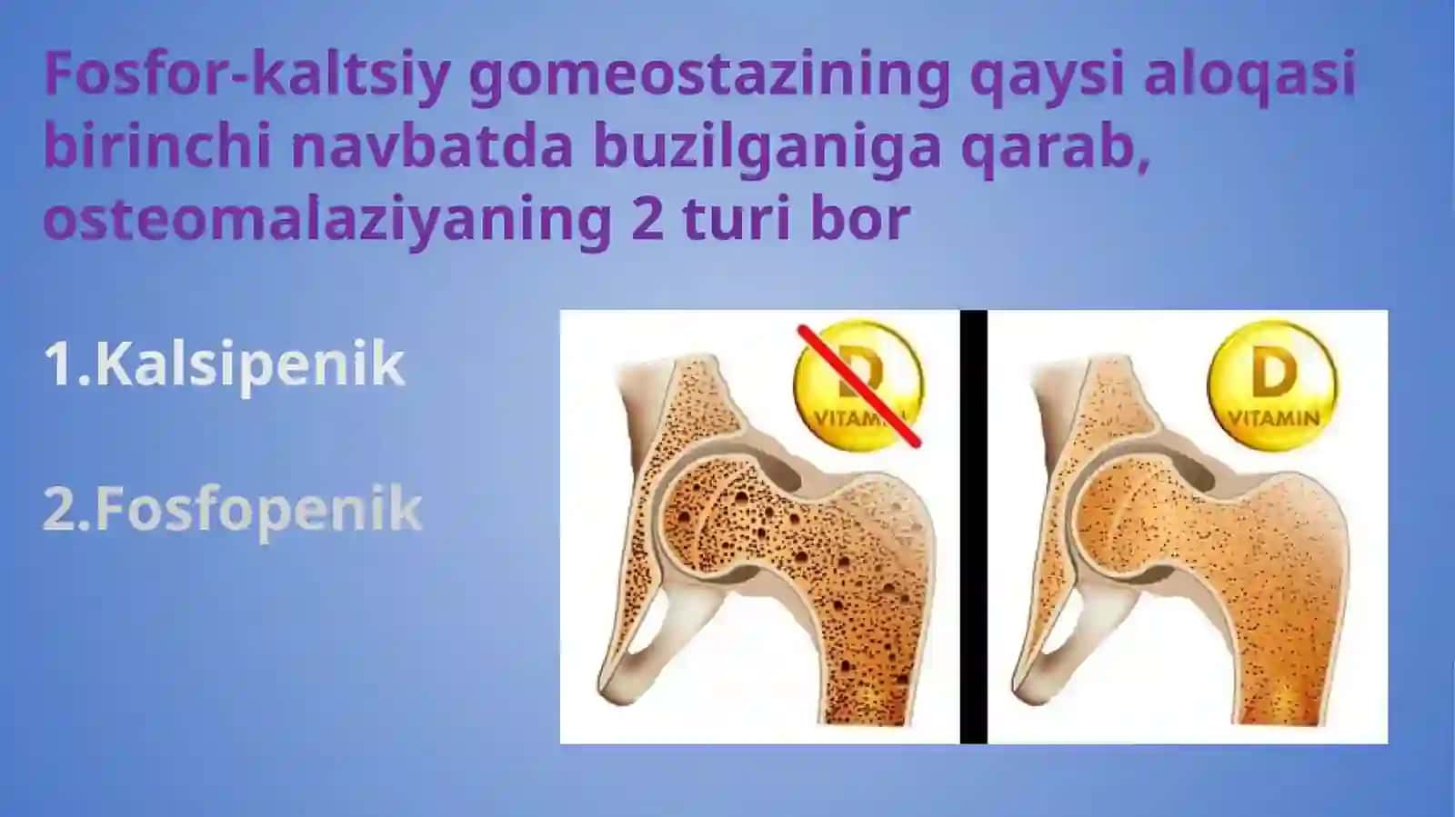 Osteomalyatsiya 4