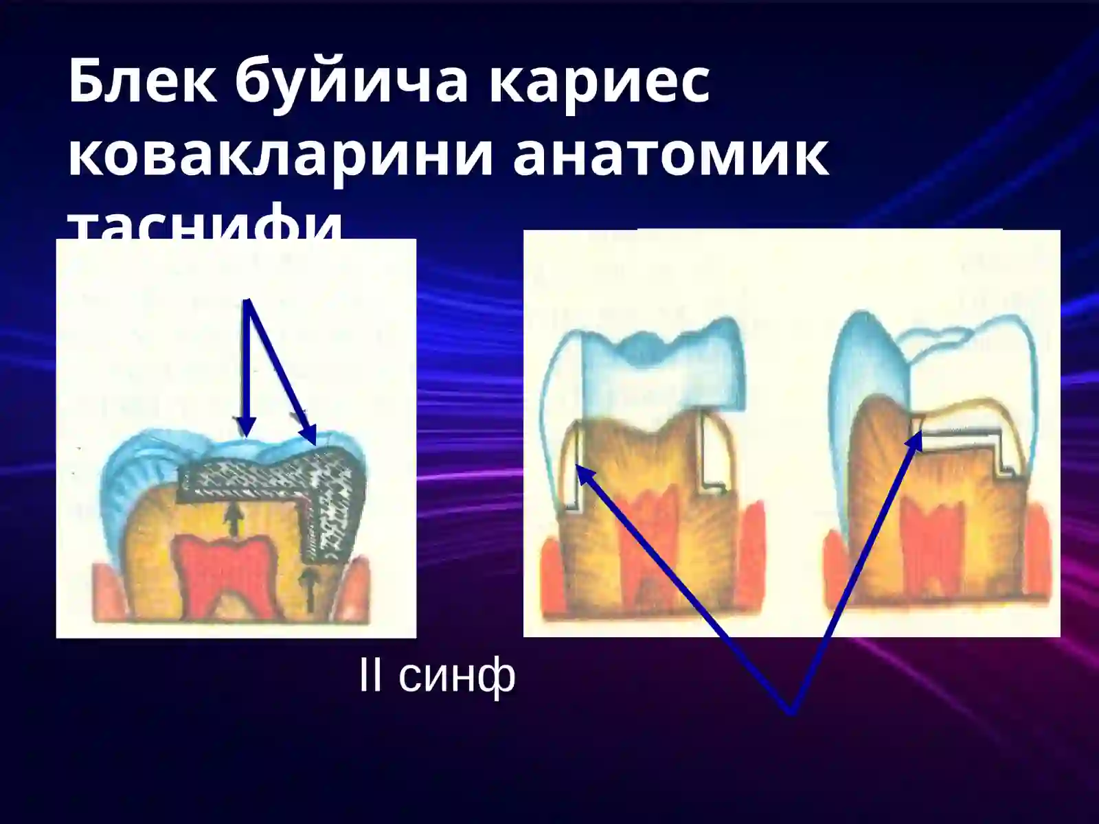 Karies kovagini charxlash bosqichlari 4