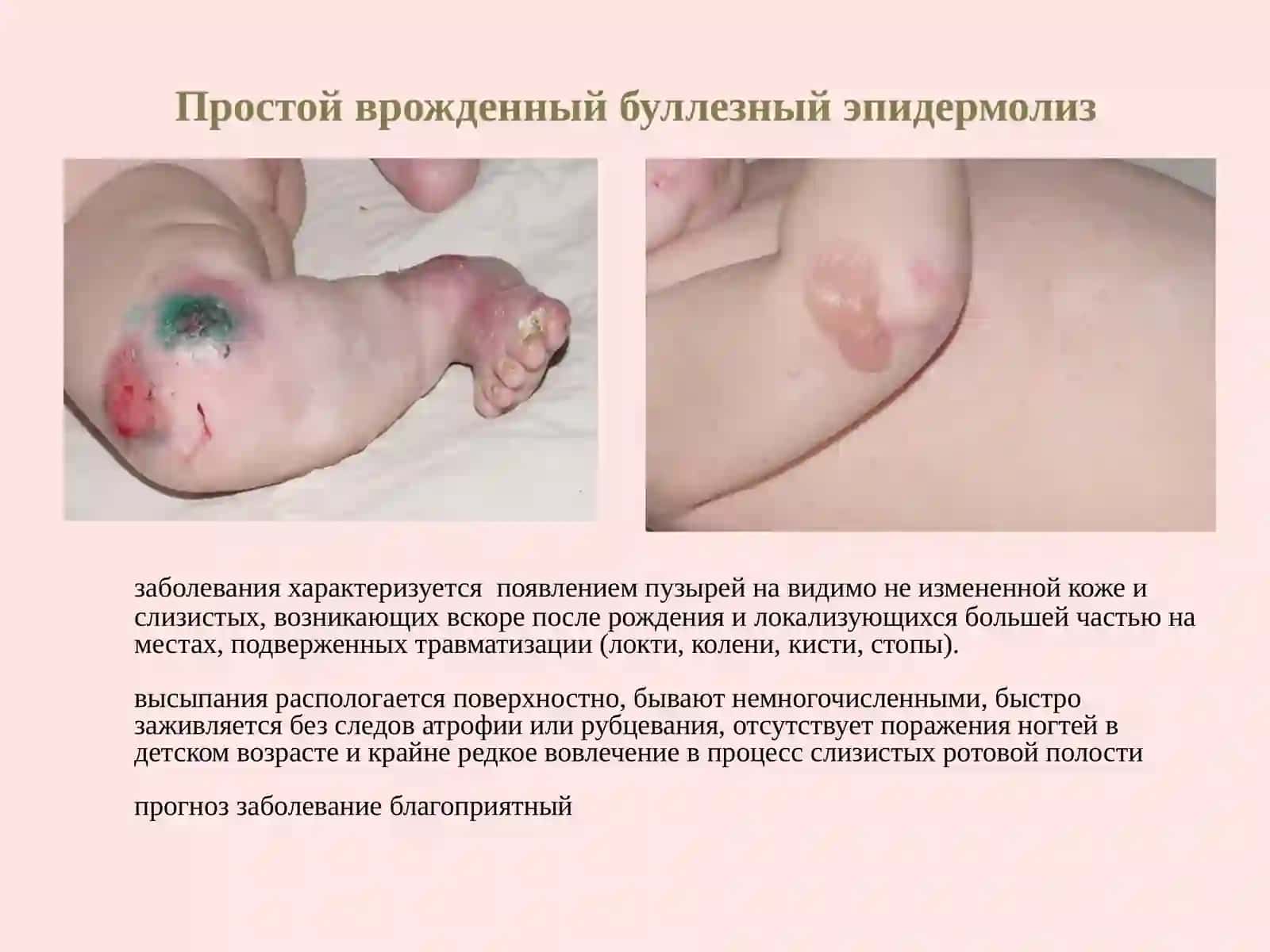 Буллезныйэпидермолиз 4