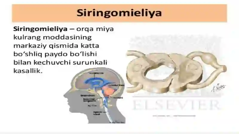 Siringomiyeliya 4