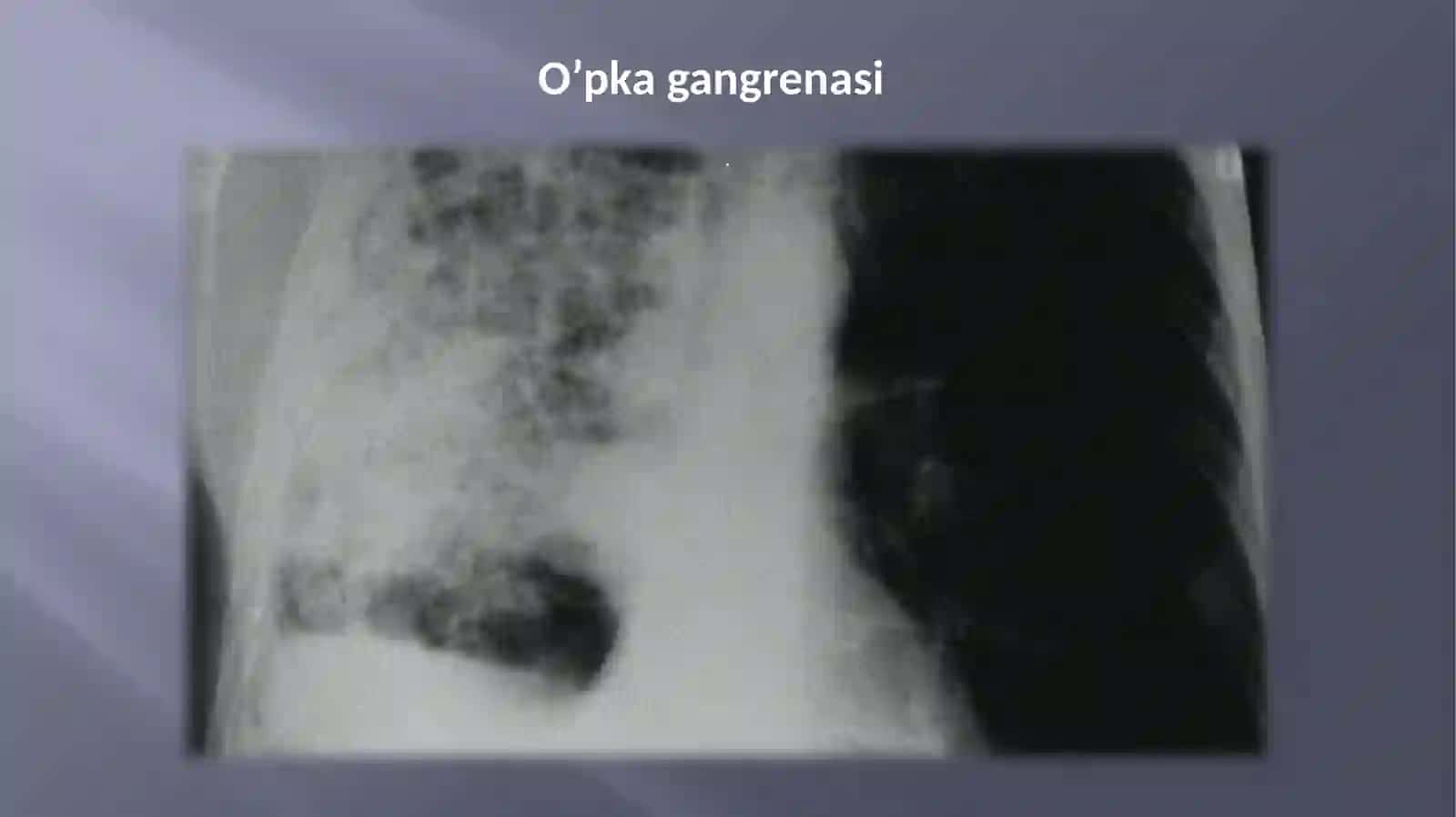 O’pka va plevraning xirurgik kasalliklari abssess va gangrenasi, plevritlar 4