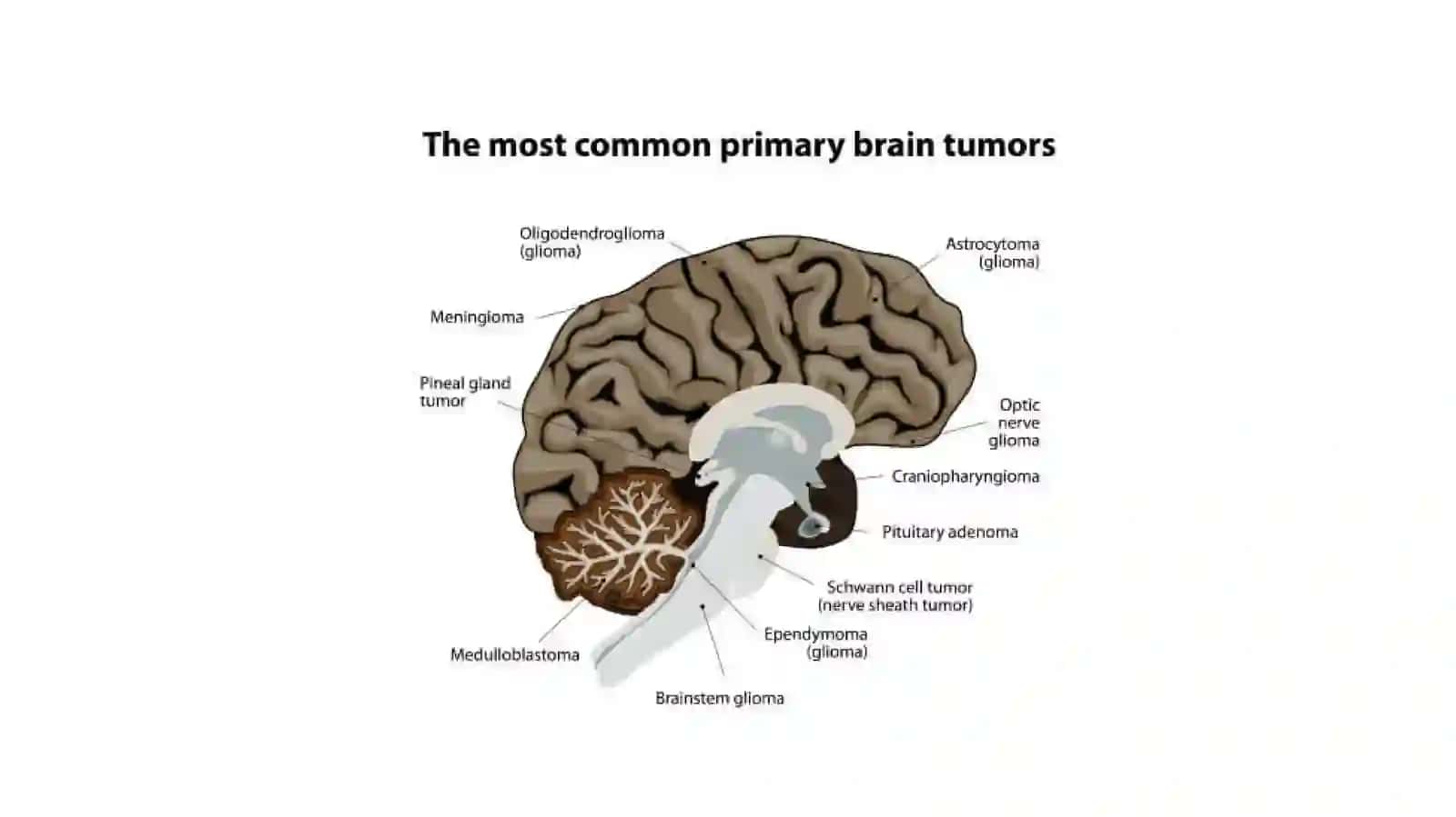Bosh miya gliomalari va meningiomalari: tasnifi, diagnostikasi va davolash 4