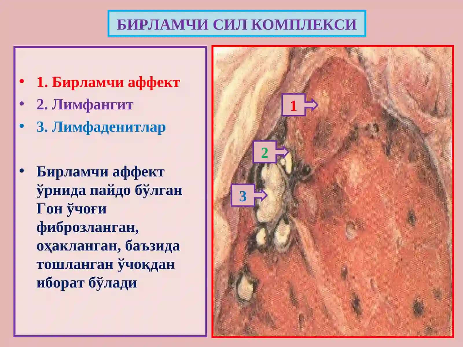 Сил - Туберкулез 4