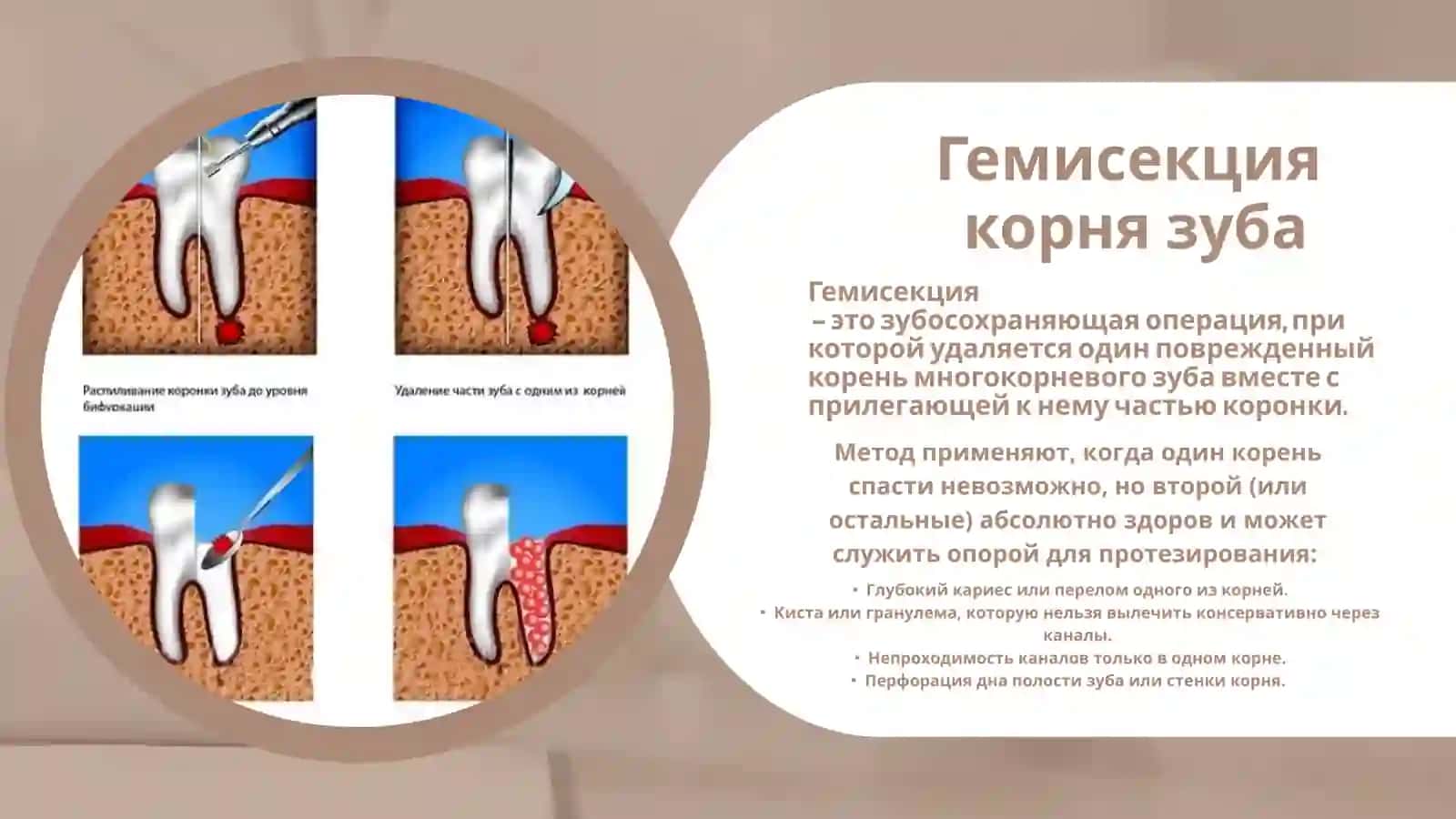 ХИРУРГИЧЕСКОЕ ЛЕЧЕНИЕ ПЕРИОДОНТИТОВ 4