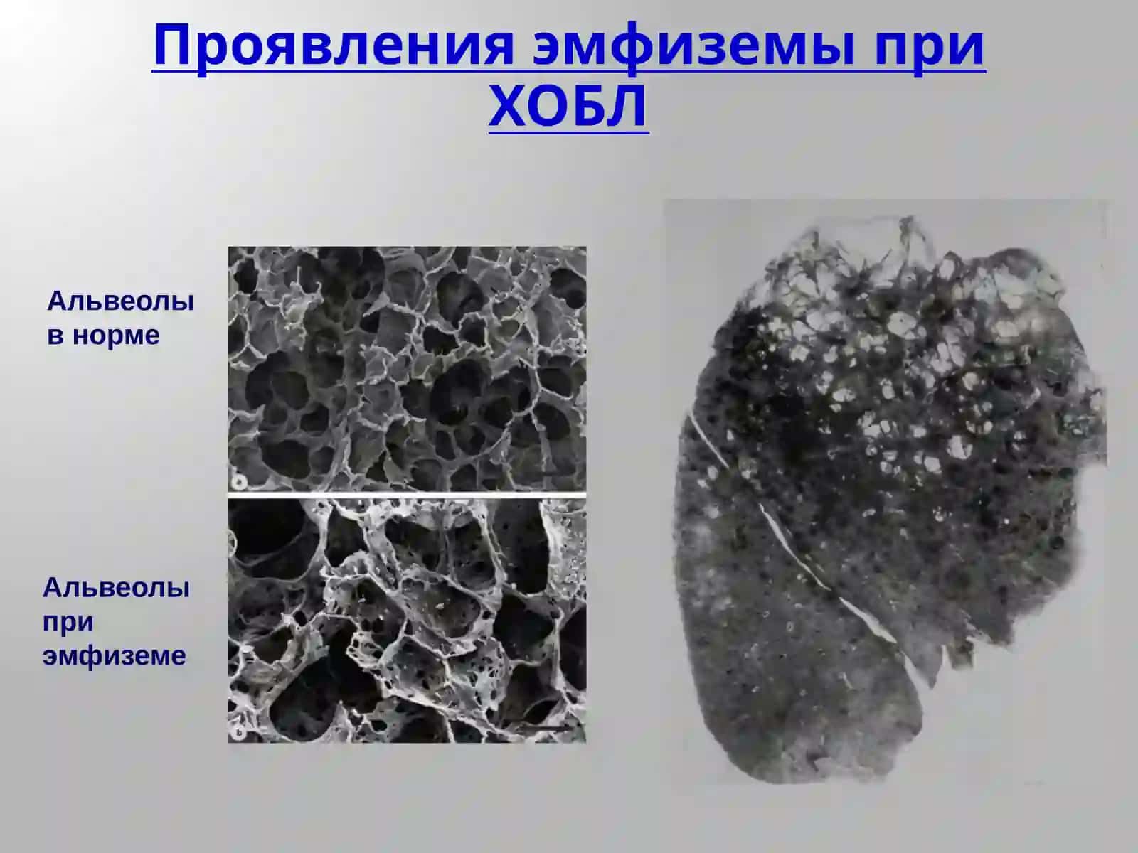 Хроническая обструктивная болезнь легких 4