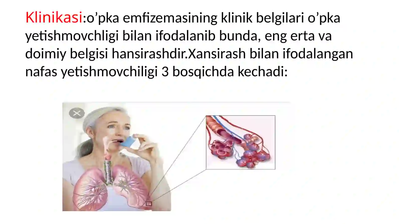 O’PKA EMFIZEMASI 4