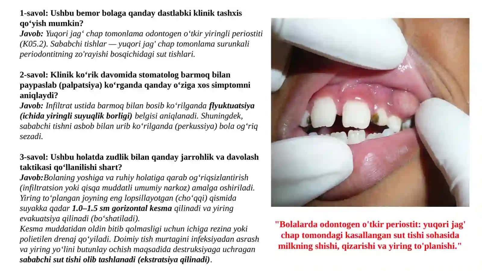 BOLALARDA JAG‘ SUYAGINING O‘TKIR VA SURUNKALI PERIOSTITI 4