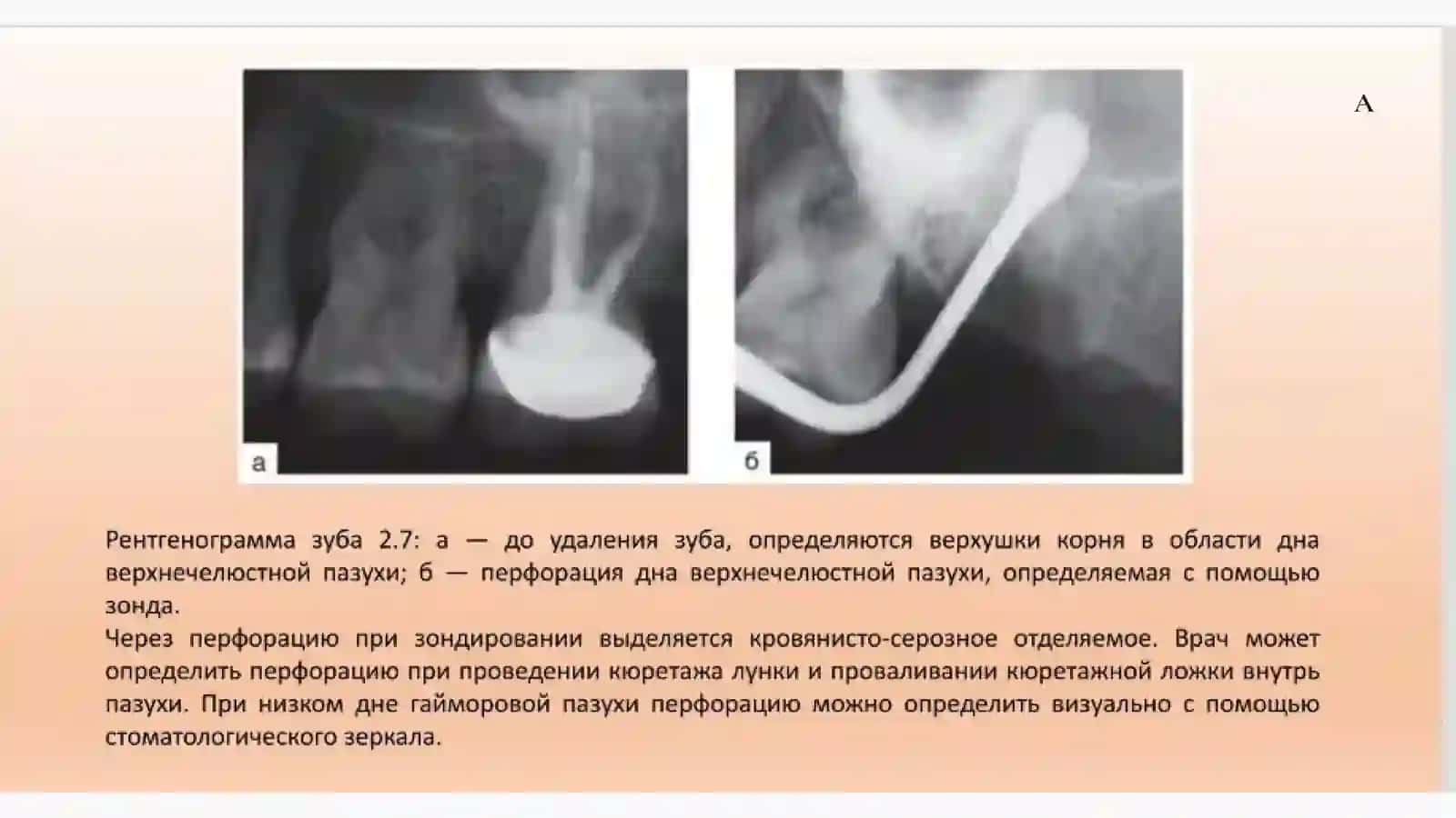 Причины перфоративного синусита 4