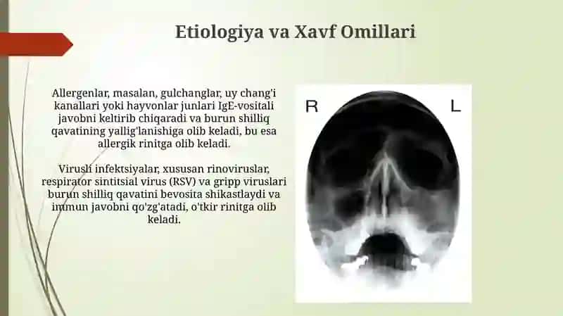 Yugori nafas yo’llari yallig’lanish kasalliklarida (rinit) F. Yo tamoillari 4