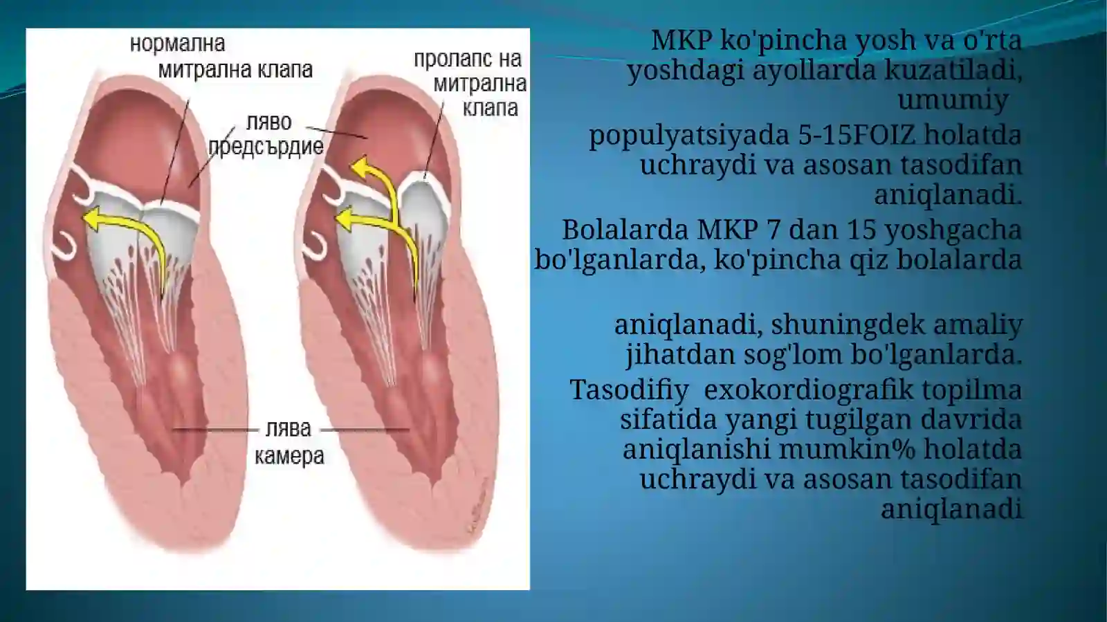 MITRAL KLAPAN PROLAPSI 4