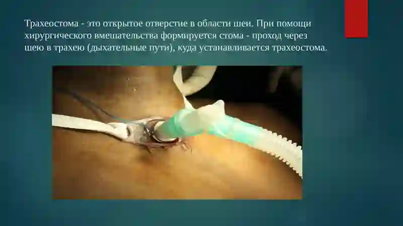 Презентация на тему"СТОМЫ" 4