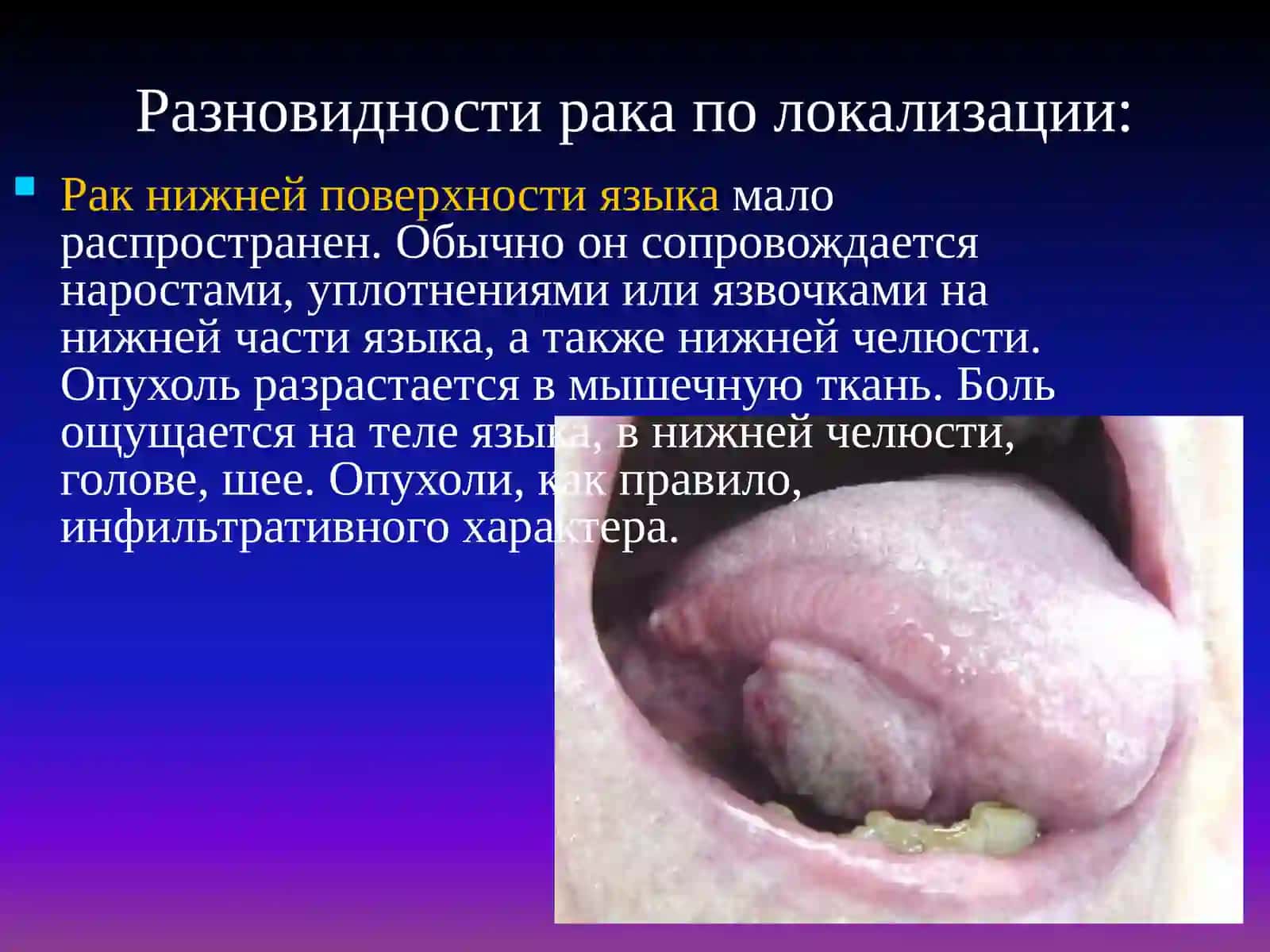 Рак корня языка 4