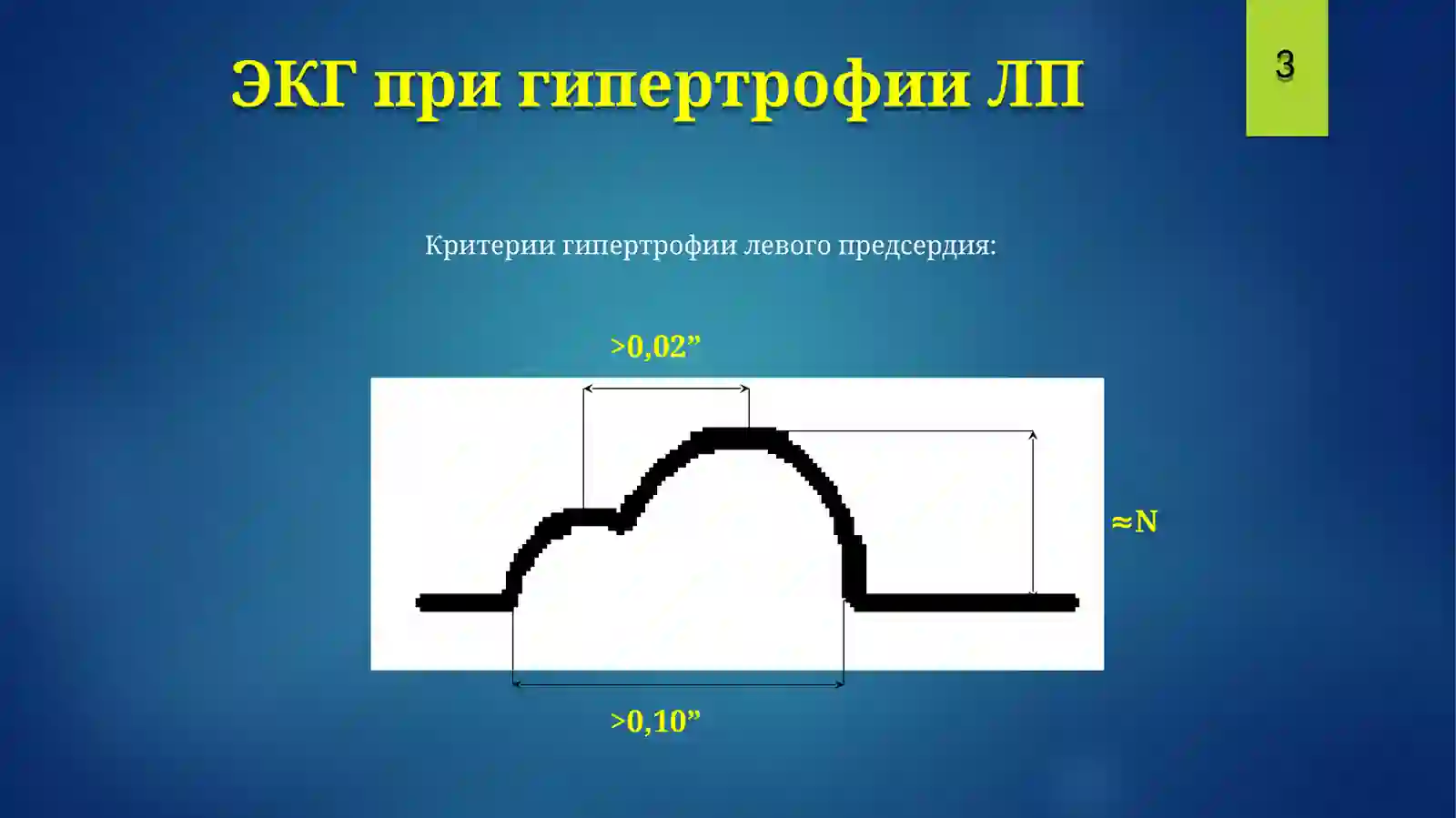 ЭКГГипертрофии, блокады 4