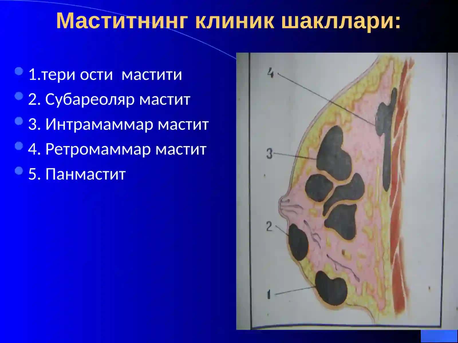 Мастит 4