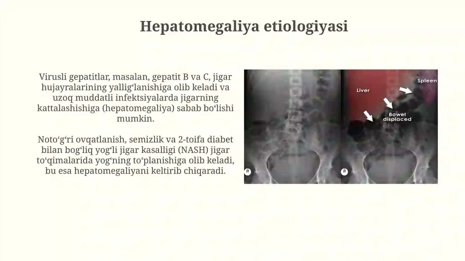 Gepatomegaliya bilan kechuvchi kasalliklar 4