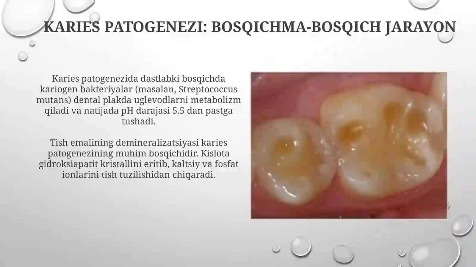 Kariesning etiologiyasi va patogenezi 4