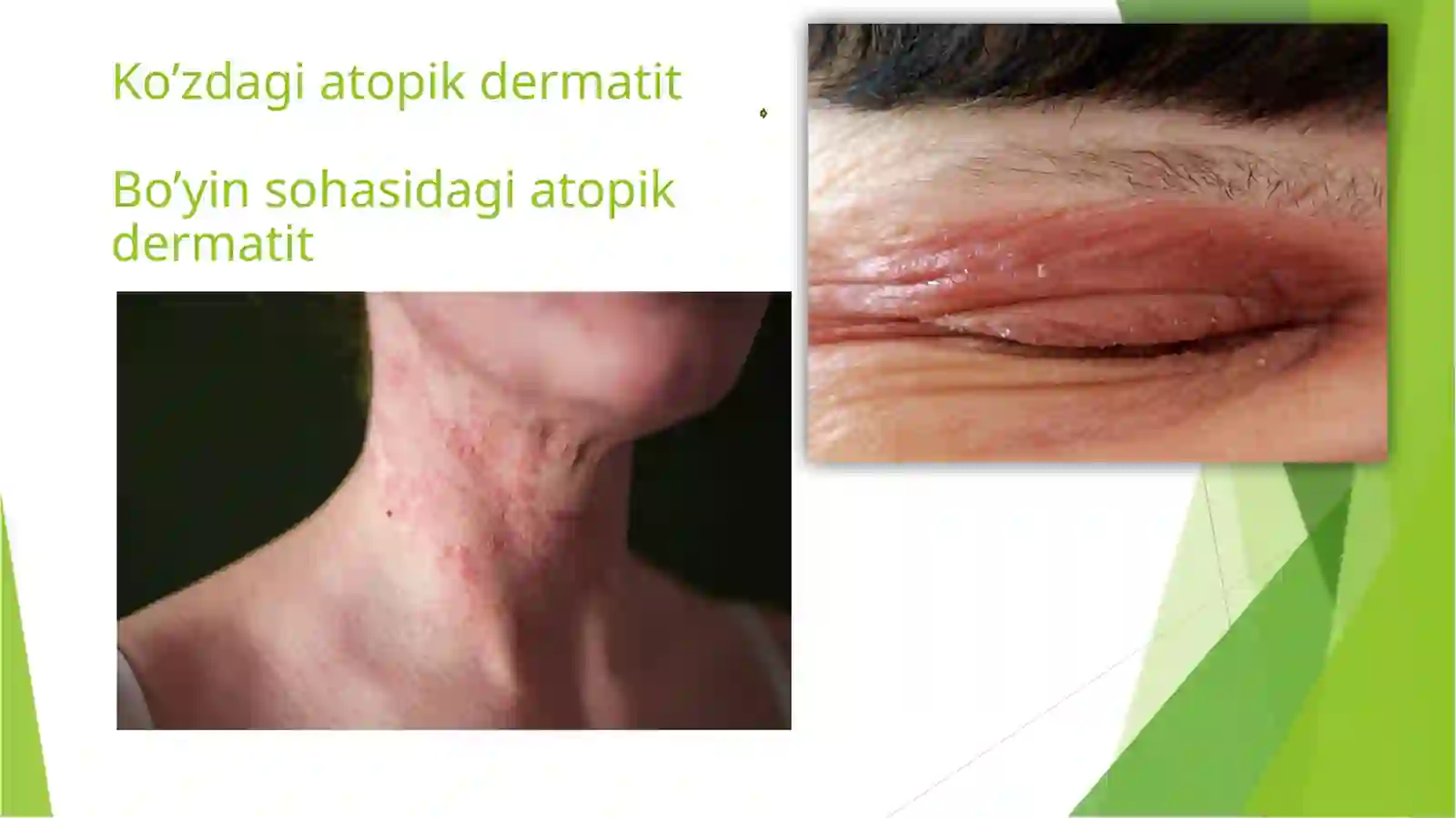 ATOPIK DERMATIT 4