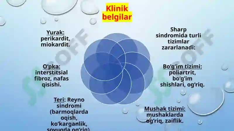 SHARP SINDROMI. SHEGREN KASALLIGI. 4