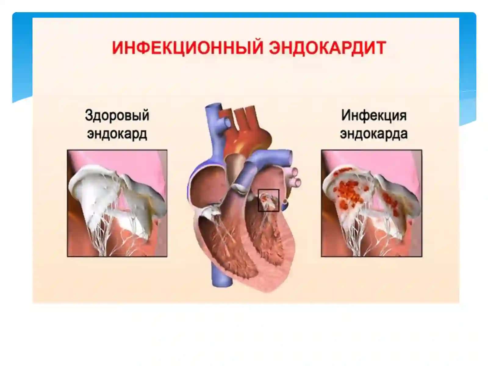 Infeksion endokardit Diagnostikasi davolashi 4