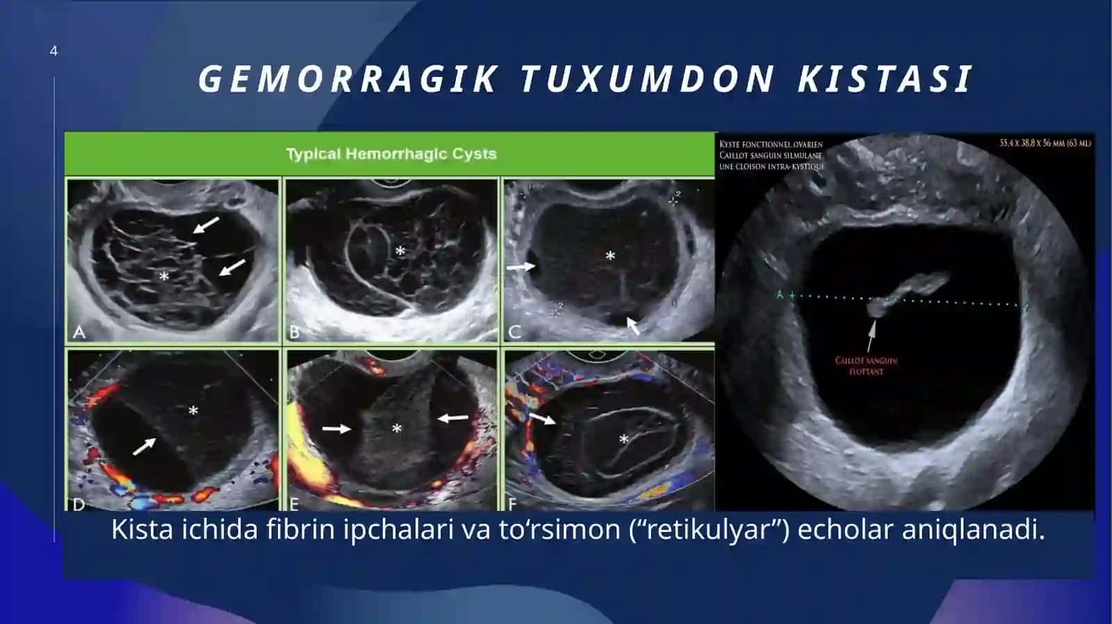 Tuxumdonlar kistasida UTT diagnostikasi 4