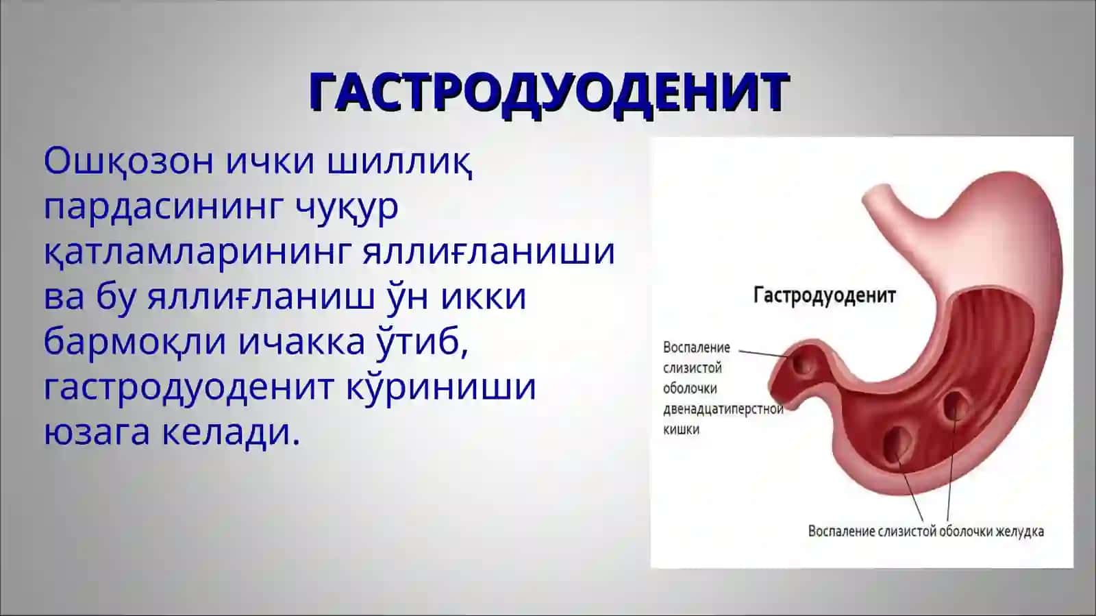 Болаларда гастрит ва гастродуоденитларнинг этиологияси, ташхисоти, клиник белгилари ва даволаш 4