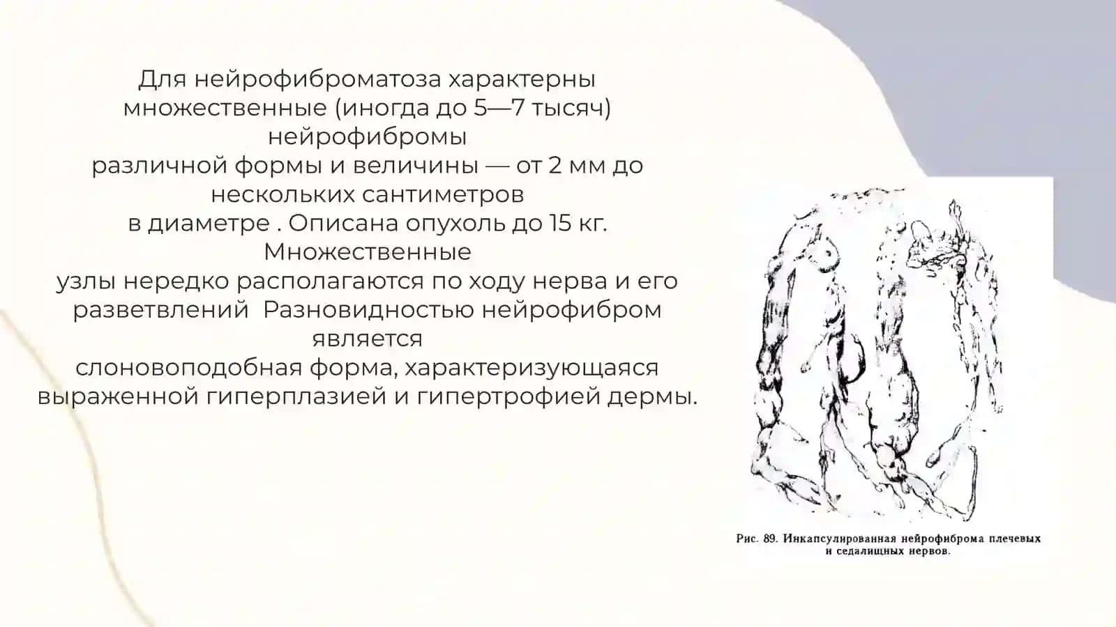 МНОЖЕСТВЕННЫЙ НЕЙРОФИБРОМАТОЗ 4
